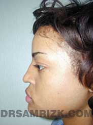 pic Female before Nose Surgery