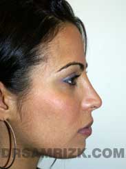 Female after Nose Surgery