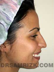 Female before Nose Surgery