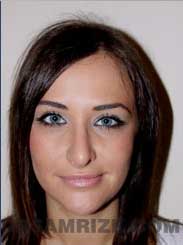 women nose surgery after picture