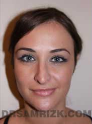 women nose job before gallery