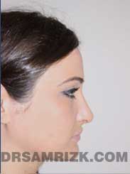 NYC Rhinoplasty Female after