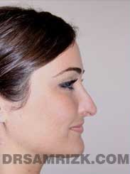 Female before Nose Job
