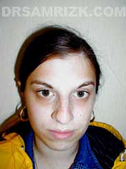 Female patient before Nose Job - picture