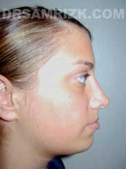 image Female after Nose Job