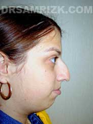 NYC Rhinoplasty Female before pic