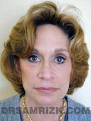 pic Female after Nose Job