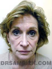 Female before Nose Job - pic