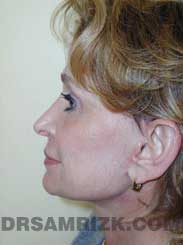 picture Female after Nose Job