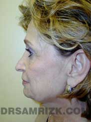 photo patient before Nose Job