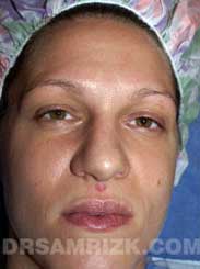 Nose Job NYC male patient before