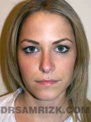 after Nose Job NYC Female pic