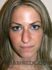 before Nose Job NYC Female pic