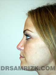 Female after nose surgery - side view