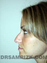 Female before nose surgery - side view