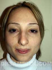 Female before nose surgery - front view