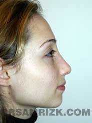 before Nose Job women image