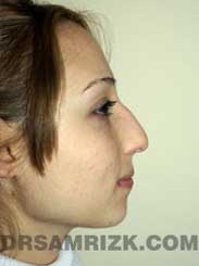 after Nose Job women image