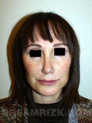 picture Female patient after Nose Job