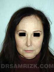 picture Female patient before Nose Job