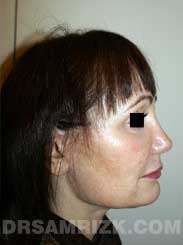 Female after nose job - side view