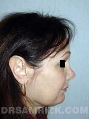 Female before nose job - side view