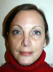 Female patient after septorhinoplasty - front view