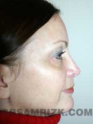 Female after nose job - side pic