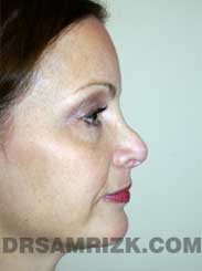 Female before nose job - side pic