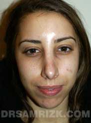 Female patient Post-Op rhinoplasty - front view
