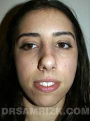 Female patient Pre-Op rhinoplasty - front view