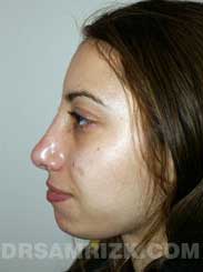 Female patient after rhinoplasty - pic