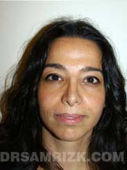 Female patient after rhinoplasty - photo