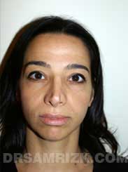 Female patient before rhinoplasty - photo