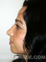 Female patient Post-Op rhinoplasty - photo