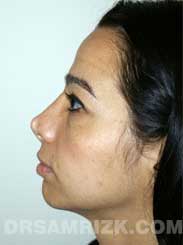 Female patient Pre-Op rhinoplasty - photo