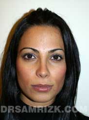 photo Female after Nose Job
