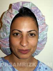 Female patient before Nose Job