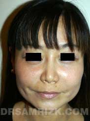 photo Female after Rhinoplasty