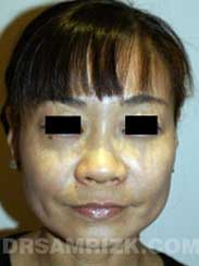 photo patient before Nose Surgery