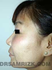image Female after Rhinoplasty