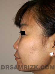 image Female before Rhinoplasty