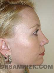 front view Female patient Post-Op rhinoplasty