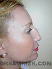 front view Female patient Preoperative rhinoplasty