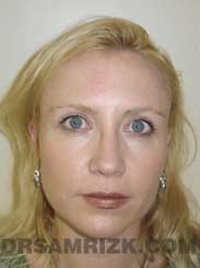 Female patient Post-Op rhinoplasty - pic