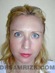 Female patient rhinoplasty Preoperative pic