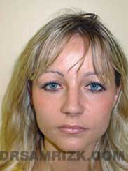 Female patient rhinoplasty Postoperative pic
