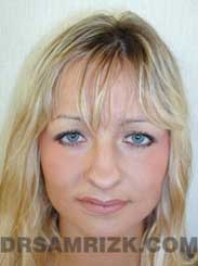 pic Female Pre-Op Nose Surgery