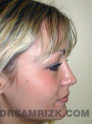 pic Female Postoperative Nose Surgery