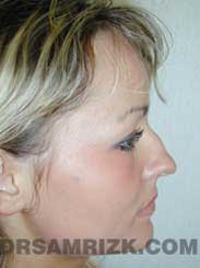 picture Female Pre-Op Nose Surgery